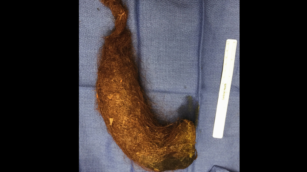 Internada com dores abdominais, mulher tinha bola de cabelo com mais de 1 kg em seu estômago